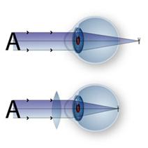 L'hypermétropie L'hypermetropie